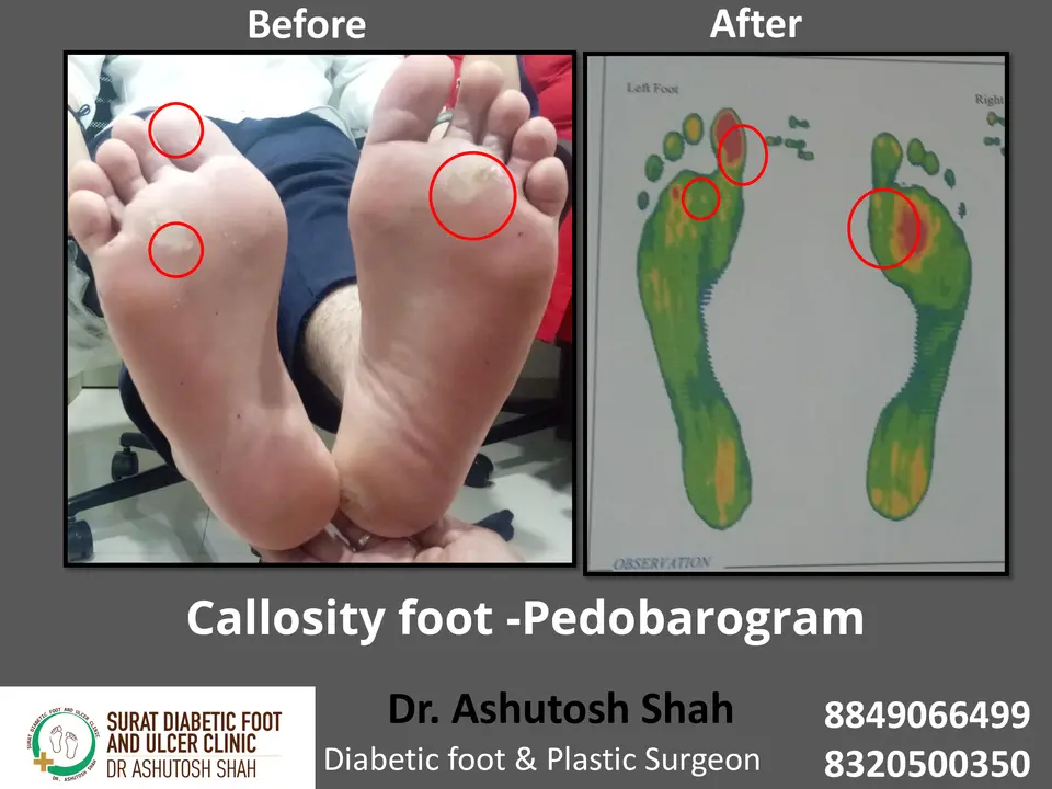 Diabetic Foot  PPT 3 checked by sir.pptx-3.webp